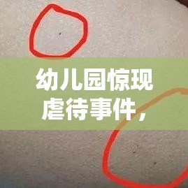 幼儿园惊现虐待事件，三岁女童身上发现29处针眼，背后真相曝光  第1张