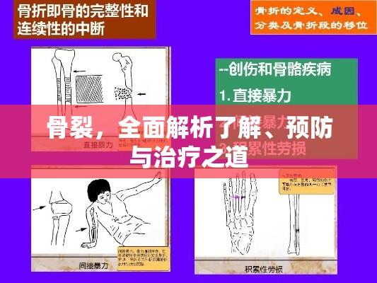 骨裂，全面解析了解、预防与治疗之道  第1张